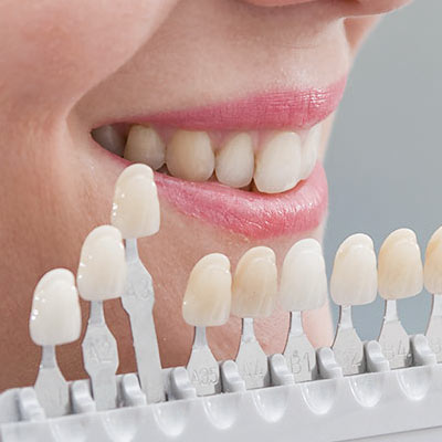 carillas dentales fuenlabrada