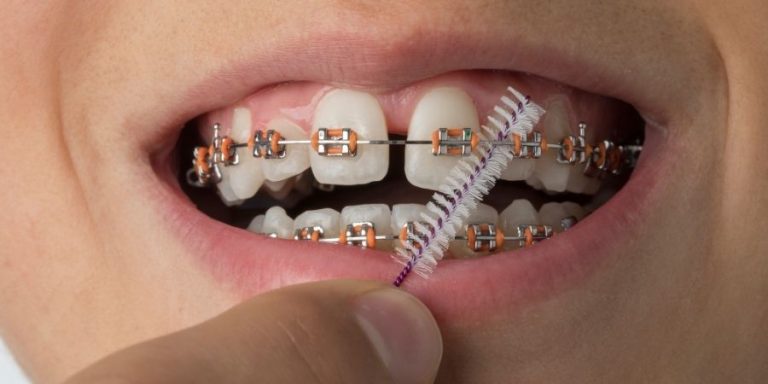 Ortodoncia convencional o Técnica Invisalign