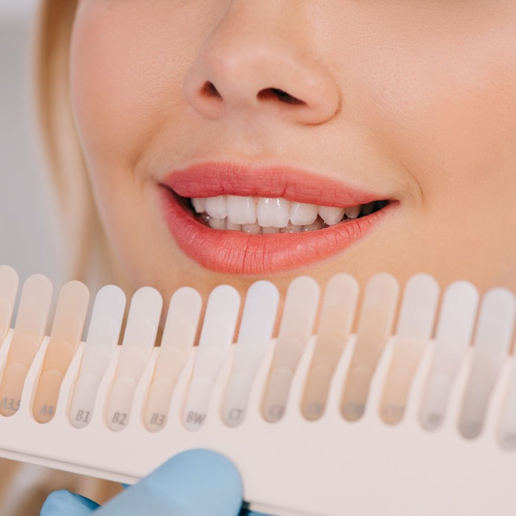 blanqueamiento dental
