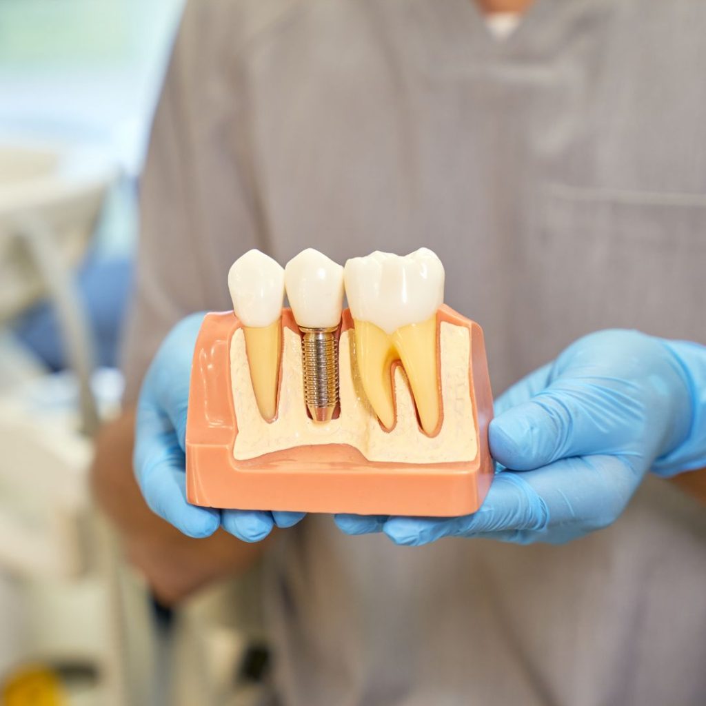 osteointegración de los implantes