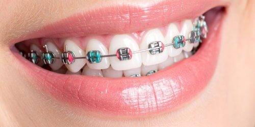 Maloclusión dental - ortodoncia